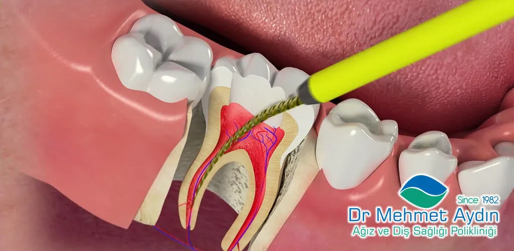  Endodonti