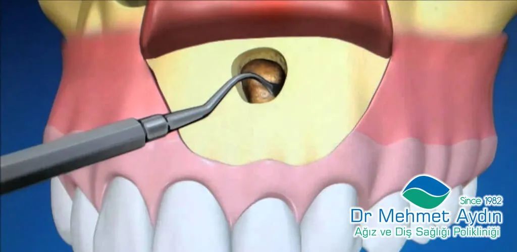  Apikal Rezeksiyon Ameliyatı