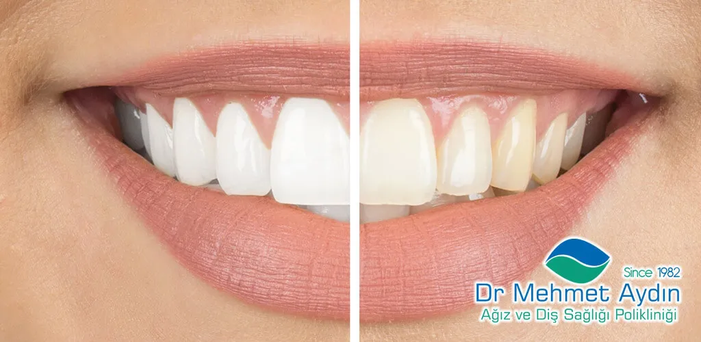 1. Sanayi Bleaching