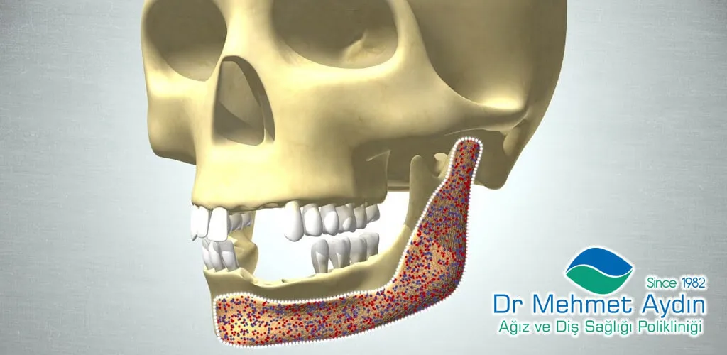 Çarıklı Çene Kemik İlavesi | Dr Mehmet Aydın Ağız ve Diş Sağlığı Polikliniği